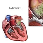 آندوکاردیت عفونی