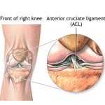 پارگی و جراحی رباط صلیبی قدامی