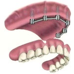 ایمپلنت دندانی   Dental implant