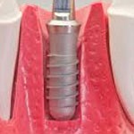 اصلاح بی دندانی کامل با ایمپلنت