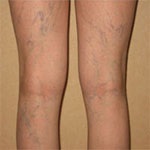 رگهای عنکبوتی