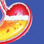 ریفلاکس معده ؛ شایع ترین بیماری گوارشی