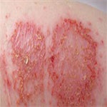 اگزما از شایع‌ترین بیماری‌های پوستی در فصل سرماست