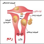 فیبروم رحمی چیست؟