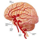 آنوریسم مغزی چیست؟