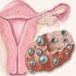آیا شانس سرطان تخمدان در روش IVF افزایش می یابد؟