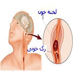 دسته بزرگ سکته مغزی