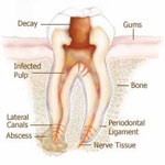 عصب‌کِشی یا درمان ریشه (Endodontic therapy, Root canal therapy)