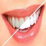 سفید کردن دندان (Bleaching)