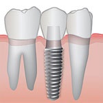 مزایای ایمپلنت دندانی نسبت به دیگر روش‌ها
