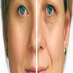 آیا تزریق ژل برای شما مناسب است ؟