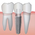 ایمپلنت (کاشت دندان)