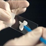 سرطان دهانه رحم در زنان