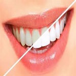 لمینیت یا لامینیت یا ونیرهای زیبایی( Laminates or Cosmatic Veneers)