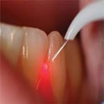 جراحی های دندان با لیزر